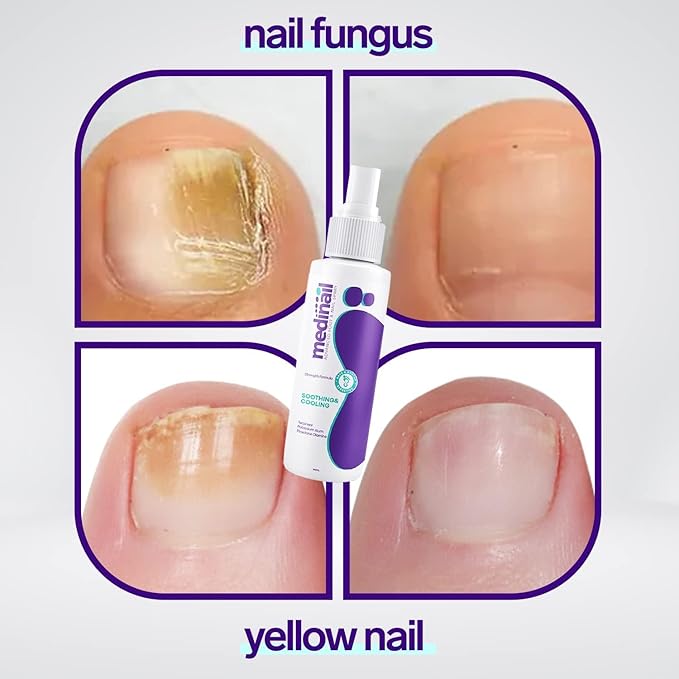 Nail Fungus Spray (Original)